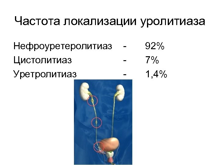 Частота локализации уролитиаза Нефроуретеролитиаз Цистолитиаз Уретролитиаз - 92% 7% 1, 4% 