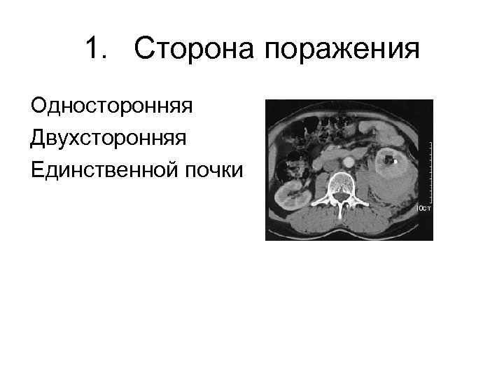 1. Сторона поражения Односторонняя Двухсторонняя Единственной почки 
