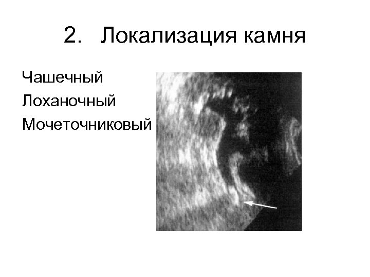 2. Локализация камня Чашечный Лоханочный Мочеточниковый 