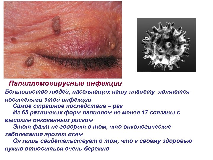 Папилломовирусные инфекции Большинство людей, населяющих нашу планету являются носителями этой инфекции Самое страшное последствие