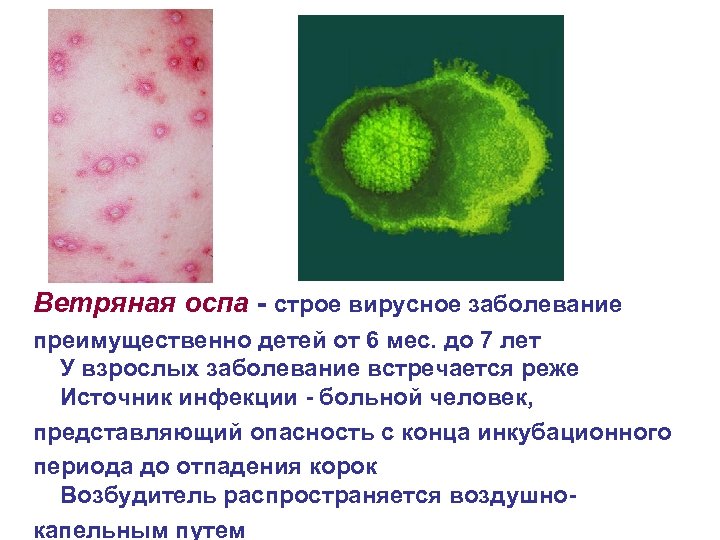 Ветряная оспа - строе вирусное заболевание преимущественно детей от 6 мес. до 7 лет