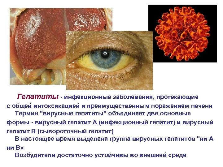 Гепатиты - инфекционные заболевания, протекающие с общей интоксикацией и преимущественным поражением печени Термин "вирусные