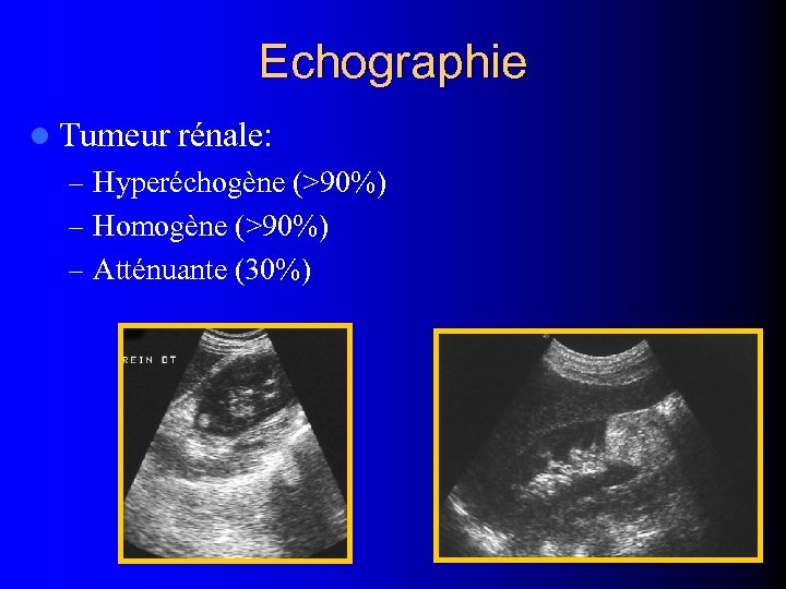 Echographie l Tumeur rénale: – Hyperéchogène (>90%) – Homogène (>90%) – Atténuante (30%) 
