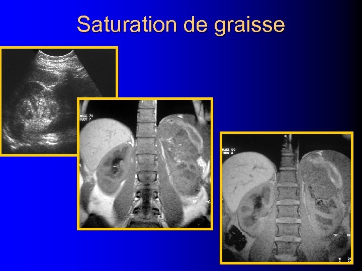 Saturation de graisse 