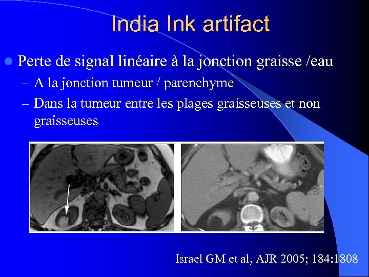 India Ink artifact l Perte de signal linéaire à la jonction graisse /eau –