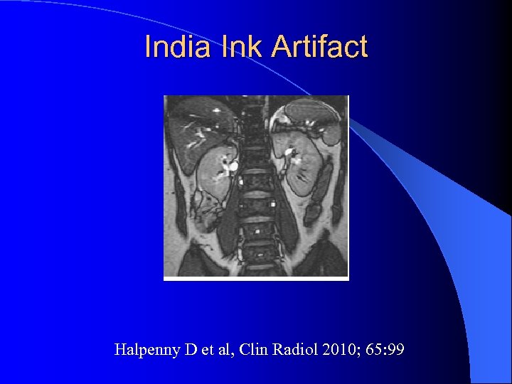 India Ink Artifact Halpenny D et al, Clin Radiol 2010; 65: 99 