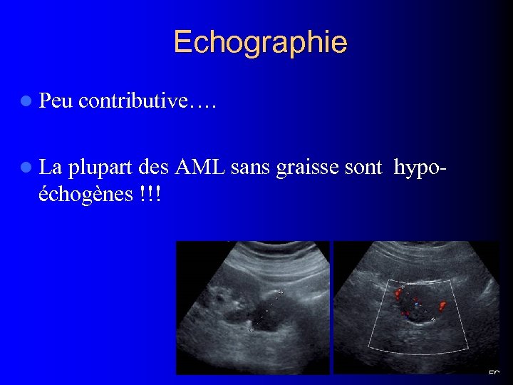 Echographie l Peu l La contributive…. plupart des AML sans graisse sont hypoéchogènes !!!