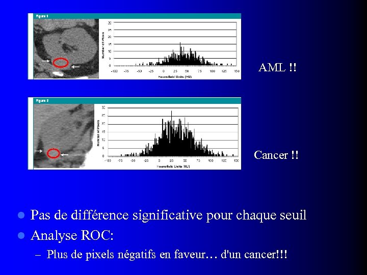 AML !! Cancer !! Pas de différence significative pour chaque seuil l Analyse ROC: