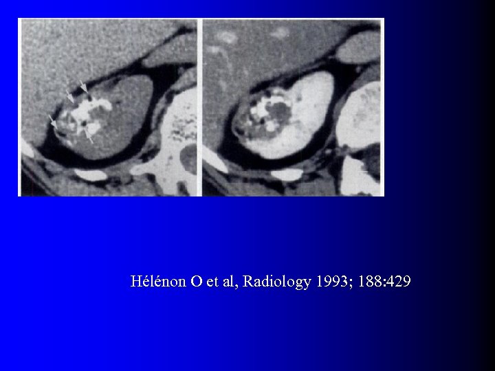 Hélénon O et al, Radiology 1993; 188: 429 