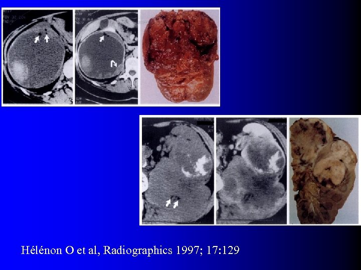 Hélénon O et al, Radiographics 1997; 17: 129 