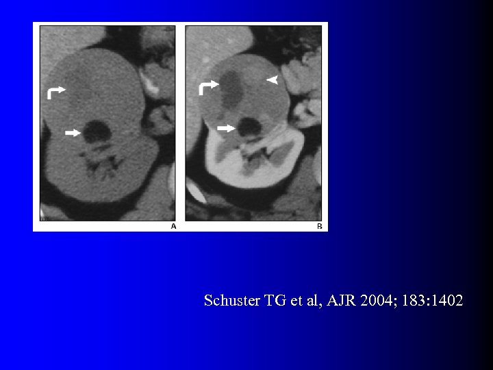 Schuster TG et al, AJR 2004; 183: 1402 