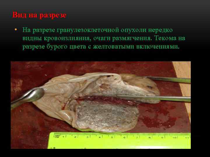 Вид на разрезе • На разрезе гранулезоклеточной опухоли нередко видны кровоизлияния, очаги размягчения. Текома