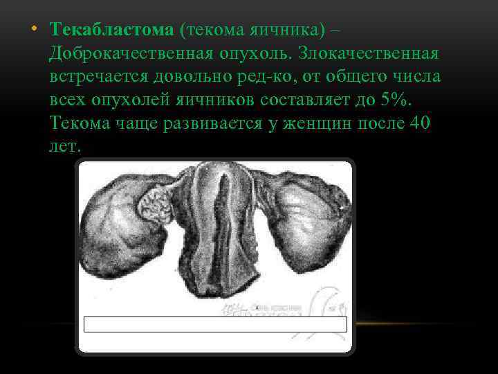  • Текабластома (текома яичника) – Доброкачественная опухоль. Злокачественная встречается довольно ред ко, от