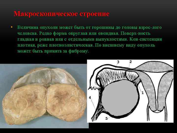Макроскопическое строение • Величина опухоли может быть от горошины до головы взрос лого человека.