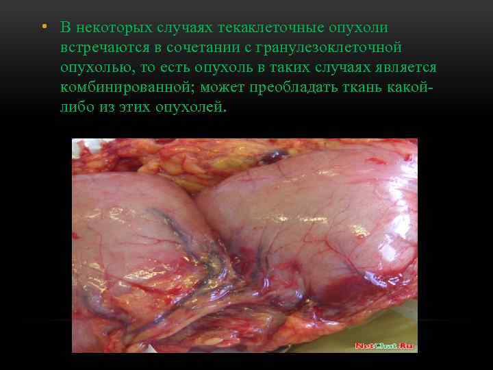  • В некоторых случаях текаклеточные опухоли встречаются в сочетании с гранулезоклеточной опухолью, то