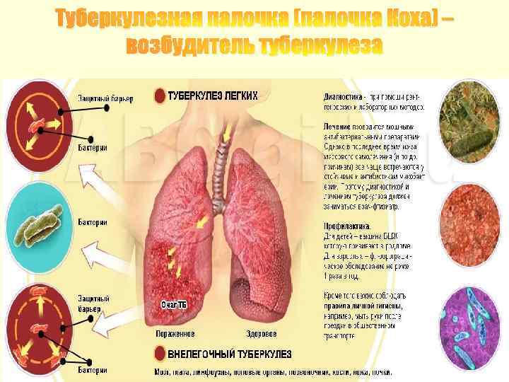 Туберкулезная палочка (палочка Коха) – возбудитель туберкулеза 