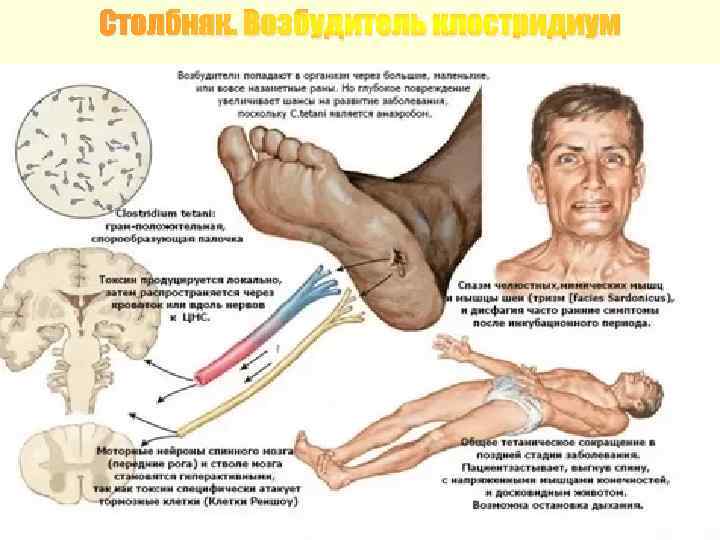 Столбняк. Возбудитель клостридиум 