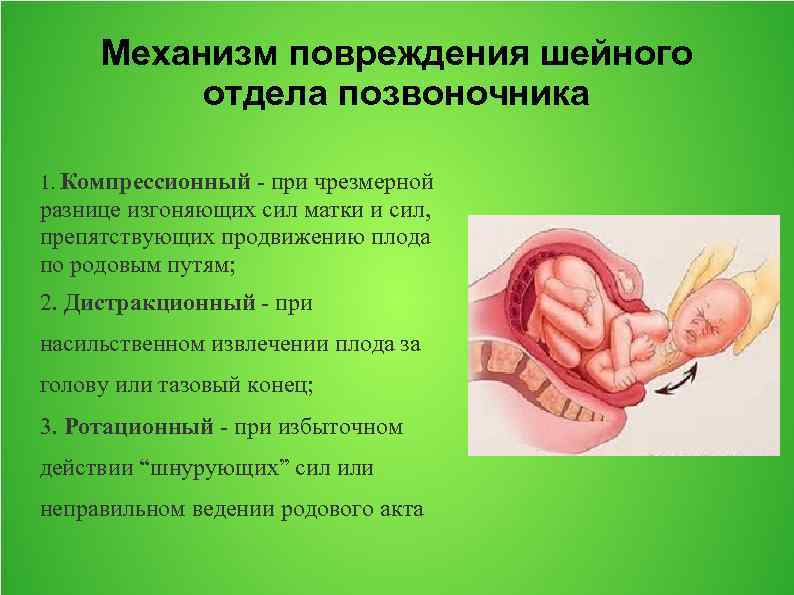 Механизм повреждения шейного отдела позвоночника 1. Компрессионный - при чрезмерной разнице изгоняющих сил матки