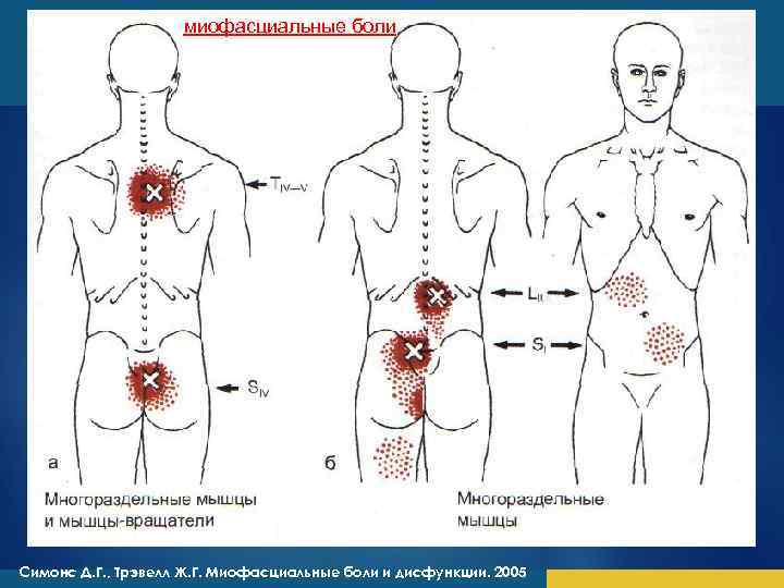 Триггерные точки спины схема