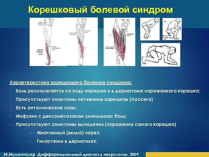 Схема лечения корешкового синдрома