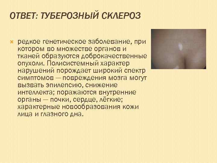 ОТВЕТ: ТУБЕРОЗНЫЙ СКЛЕРОЗ редкое генетическое заболевание, при котором во множестве органов и тканей образуются