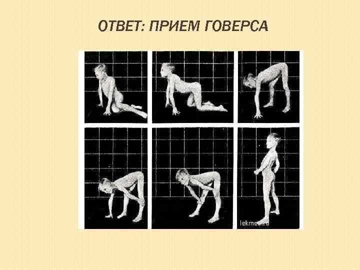 ОТВЕТ: ПРИЕМ ГОВЕРСА 