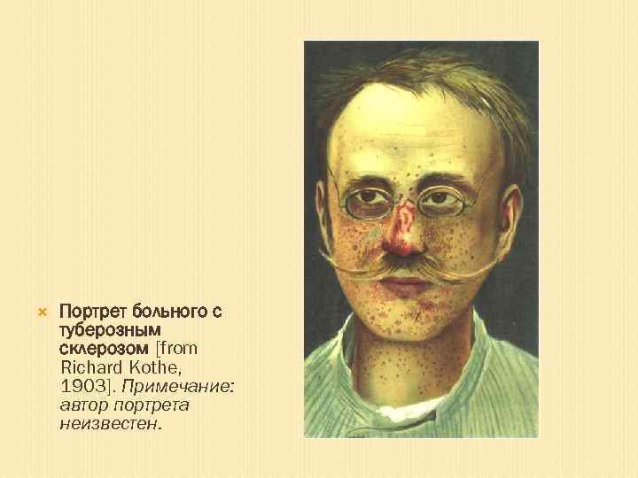  Портрет больного с туберозным склерозом [from Richard Kothe, 1903]. Примечание: автор портрета неизвестен.