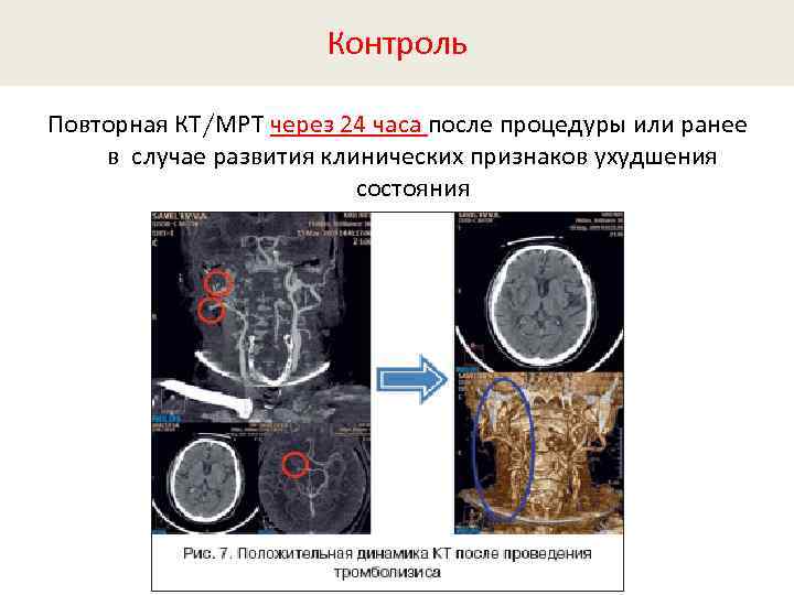 Контроль Повторная КТ/МРТ через 24 часа после процедуры или ранее в случае развития клинических