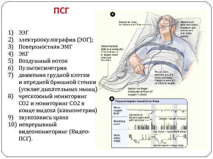 ПСГ 1) 2) 3) 4) 5) 6) 7) ЭЭГ электроокулография (ЭОГ); Поверхностная ЭМГ ЭКГ