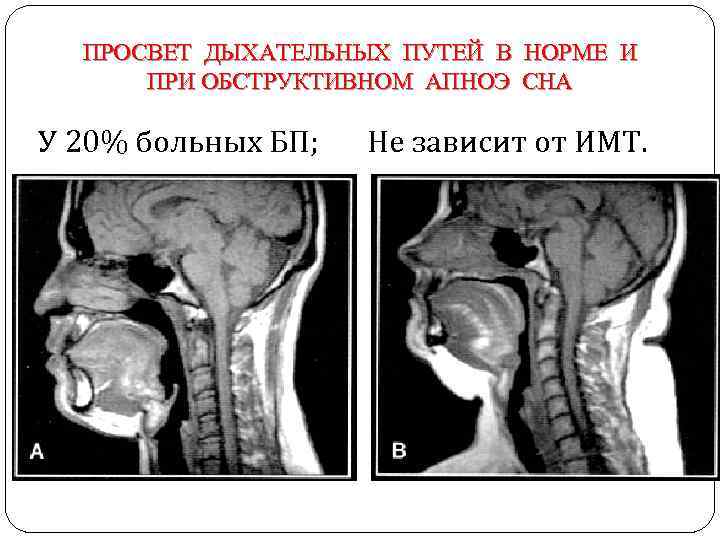 ПРОСВЕТ ДЫХАТЕЛЬНЫХ ПУТЕЙ В НОРМЕ И ПРИ ОБСТРУКТИВНОМ АПНОЭ СНА У 20% больных БП;