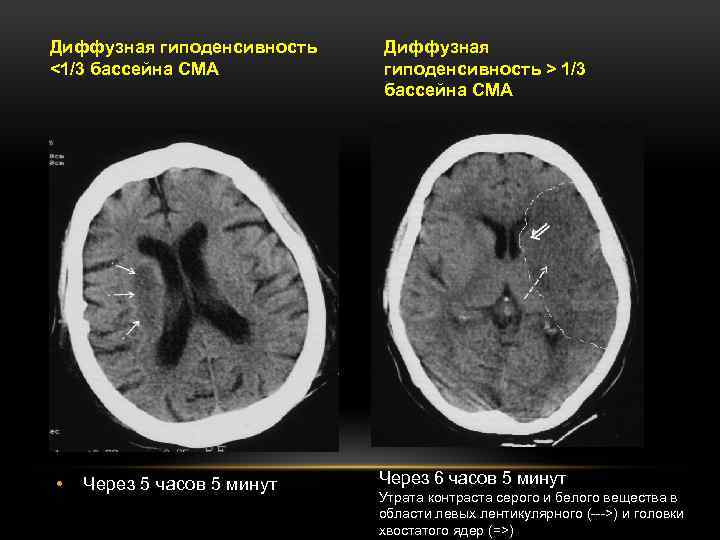 Диффузная структура. Гиподенсивность. Методы нейровизуализации ОНМК. ОНМК В бассейне СМА. Бассейн СМА на кт.