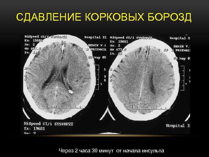 СДАВЛЕНИЕ КОРКОВЫХ БОРОЗД Через 2 часа 30 минут от начала инсульта 