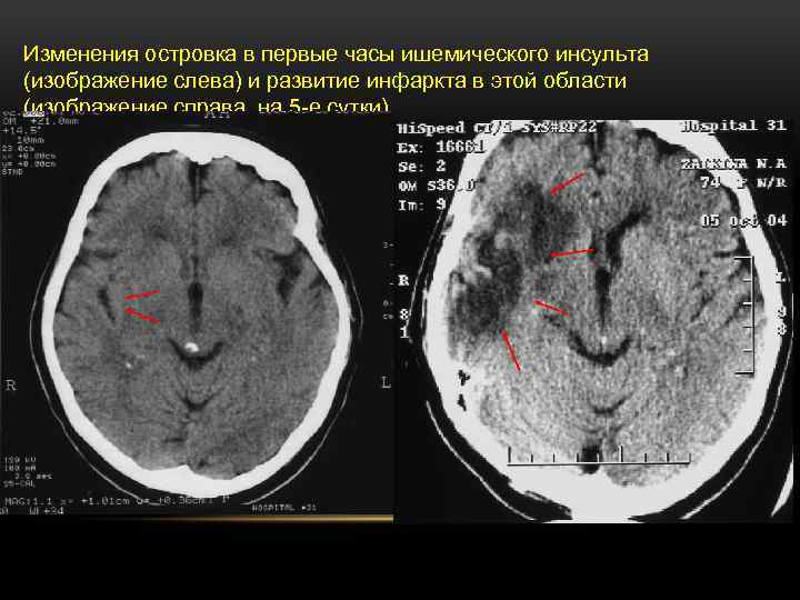 Изменения островка в первые часы ишемического инсульта (изображение слева) и развитие инфаркта в этой