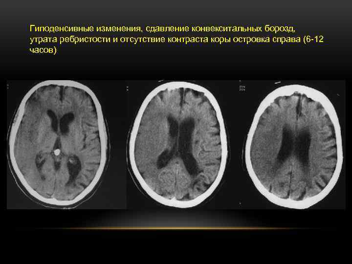 Конвекситальные субарахноидальные борозды расширены