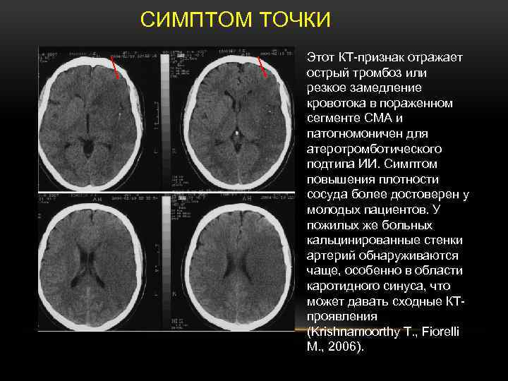 Тромбоз артерий мозга. Тромбоз синусов головного мозга кт. Тромбоз венозного синуса головного мозга кт. ОНМК гиперденсивная артерия. Синусы головного мозга кт.