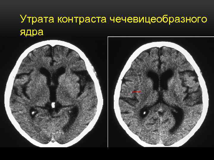 Утрата контраста чечевицеобразного ядра 
