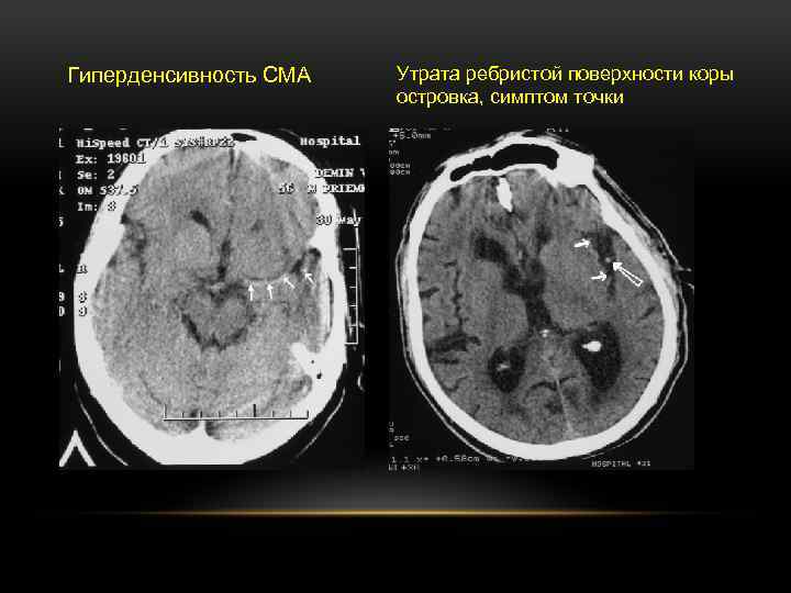 Гиперденсивность СМА Утрата ребристой поверхности коры островка, симптом точки 
