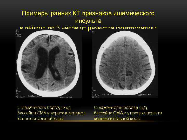 Субарахноидальные конвекситальные борозды