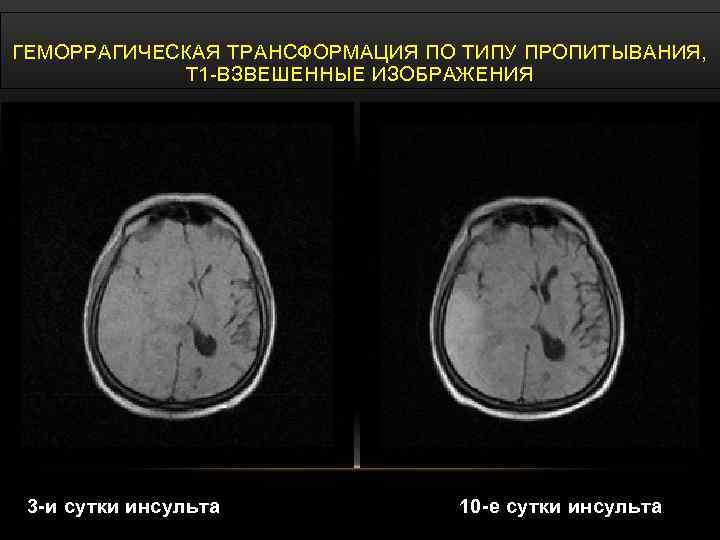 ГЕМОРРАГИЧЕСКАЯ ТРАНСФОРМАЦИЯ ПО ТИПУ ПРОПИТЫВАНИЯ, Т 1 -ВЗВЕШЕННЫЕ ИЗОБРАЖЕНИЯ 3 -и сутки инсульта 10