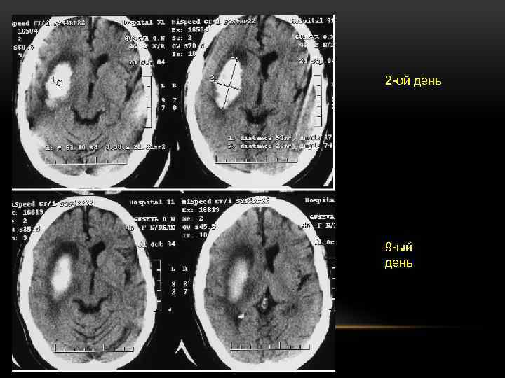 2 -ой день 9 -ый день 