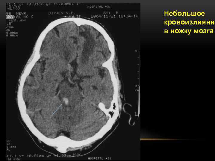 Кровоизлияние в мозг микроскопическая картина
