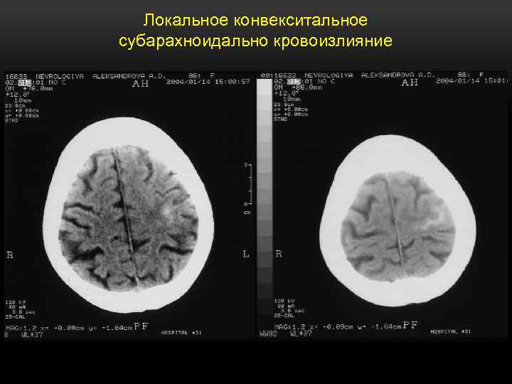 Картина умеренного расширения субарахноидального конвекситального пространства