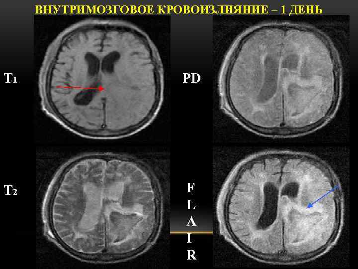 ВНУТРИМОЗГОВОЕ КРОВОИЗЛИЯНИЕ – 1 ДЕНЬ Т 1 PD Т 2 F L A I