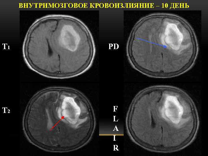 ВНУТРИМОЗГОВОЕ КРОВОИЗЛИЯНИЕ – 10 ДЕНЬ Т 1 PD Т 2 F L A I