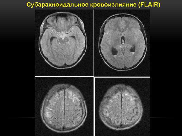 Субарахноидальное кровоизлияние (FLAIR) 