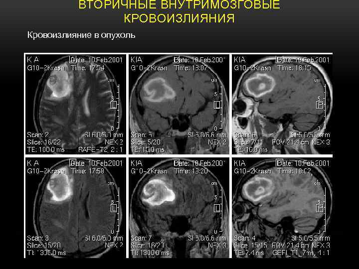 ВТОРИЧНЫЕ ВНУТРИМОЗГОВЫЕ КРОВОИЗЛИЯНИЯ Кровоизлияние в опухоль 