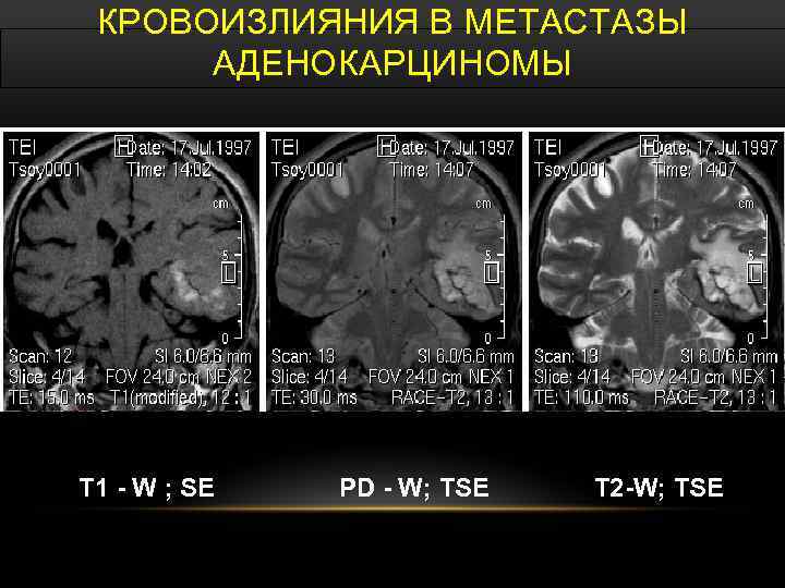 КРОВОИЗЛИЯНИЯ В МЕТАСТАЗЫ АДЕНОКАРЦИНОМЫ T 1 - W ; SE PD - W; TSE