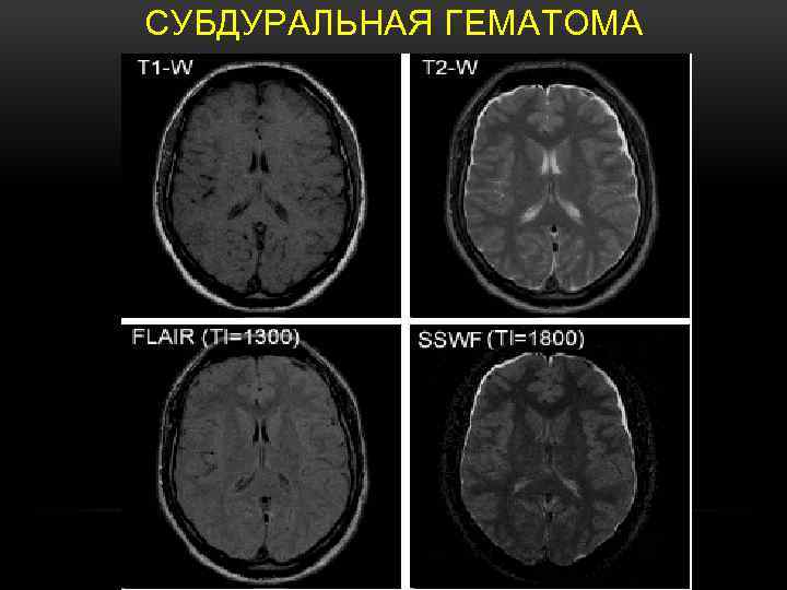 СУБДУРАЛЬНАЯ ГЕМАТОМА 