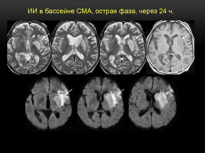 Левая средняя мозговая артерия инсульт. ОНМК В бассейне СМА. ОНМК В бассейне левой средней мозговой артерии.