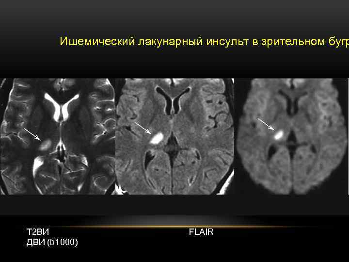 Лакунарная деменция